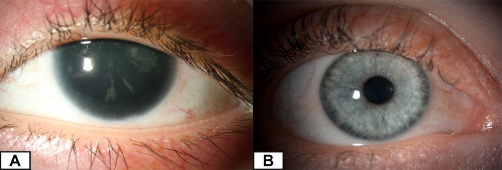 Comparison between an eye affected by aniridia which has no iris and a normal eye which has a hazel coloured iris. 