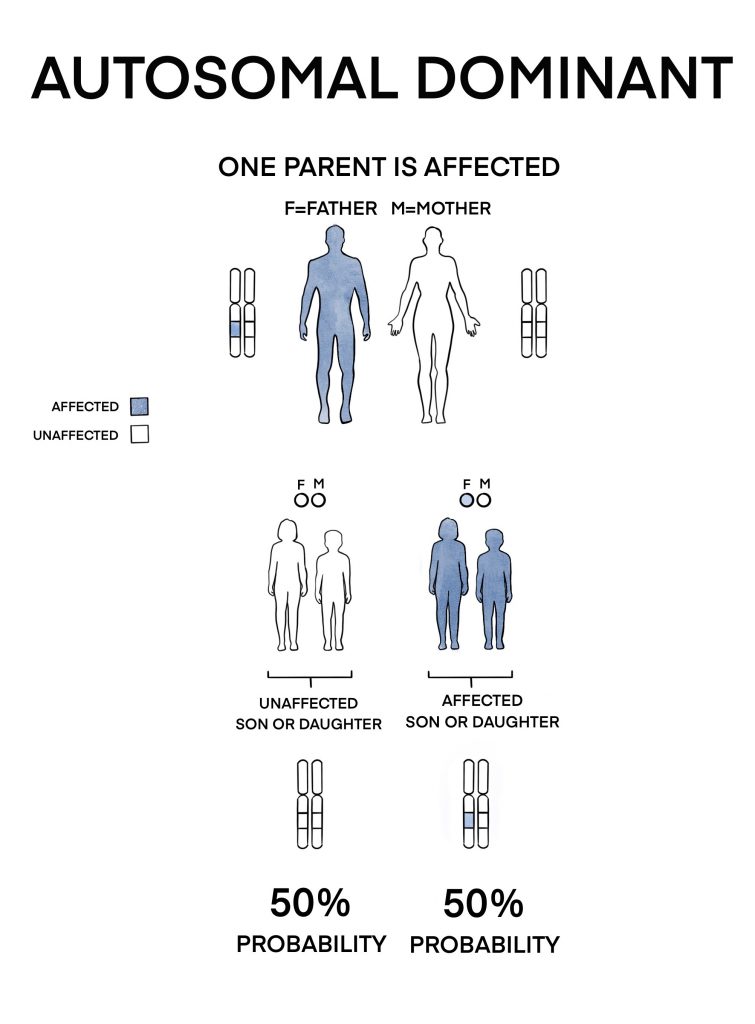 The faulty gene copy is present in the father while the mother is not affected. Each newborn of this couple has a 50% chance to be affected by the condition.